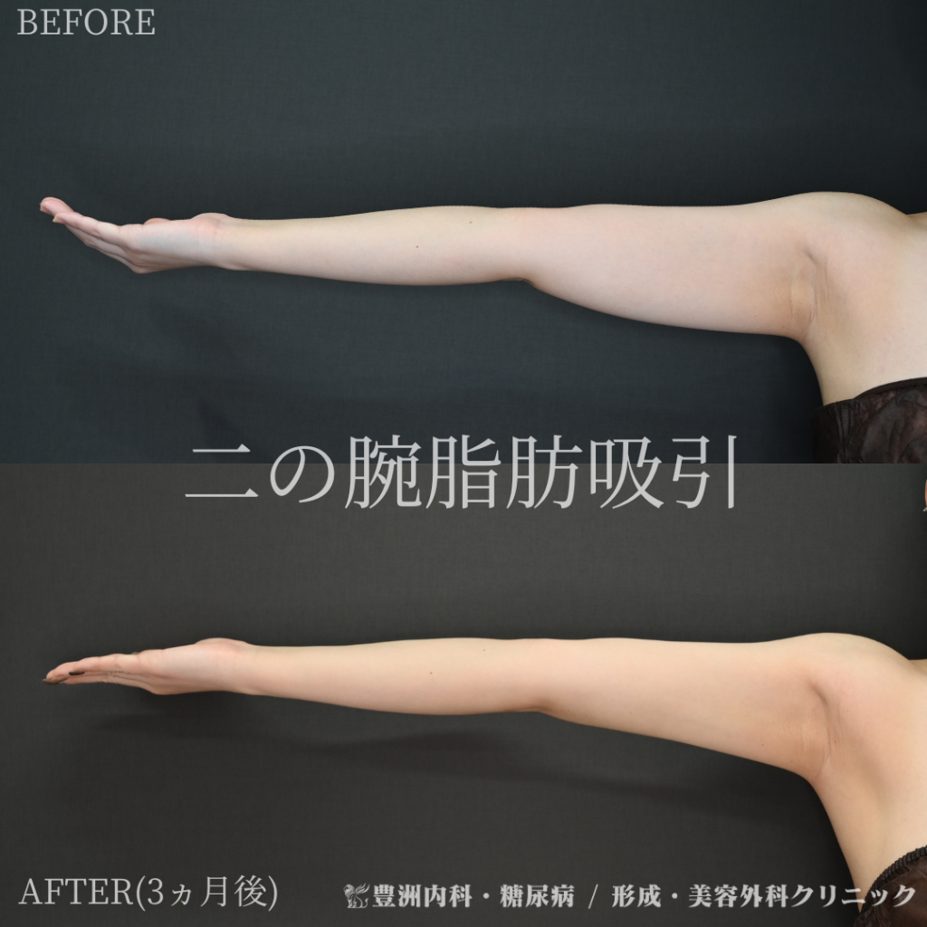 二の腕脂肪吸引 / 20代女性